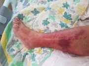 My Strange n Surprising Summer Staycation with Cellulitis